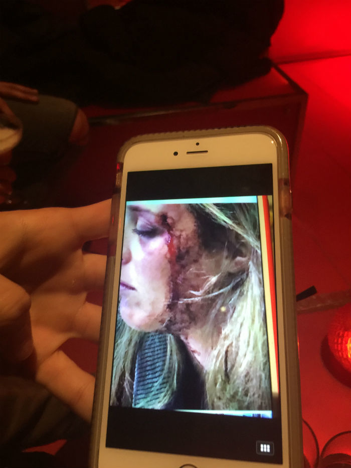 Afbeelding van hoofdletsel die een Amerikaanse vrouw tijdens een ongeluk met een e-bike in Shanghai heeft opgedaan.